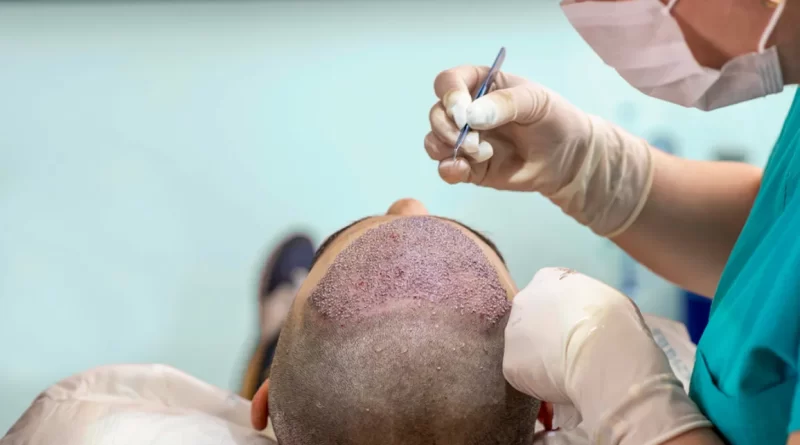 Hair Transplant Cost