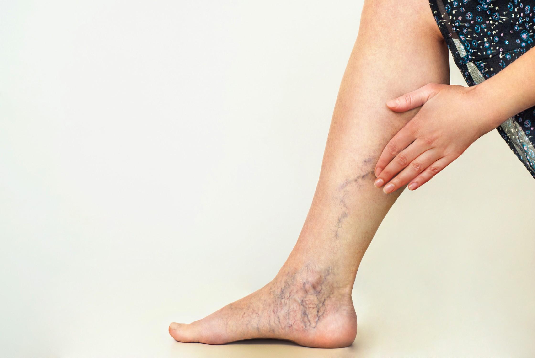 how much does varicose vein treatment cost