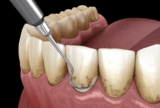 dental scaling and polishing