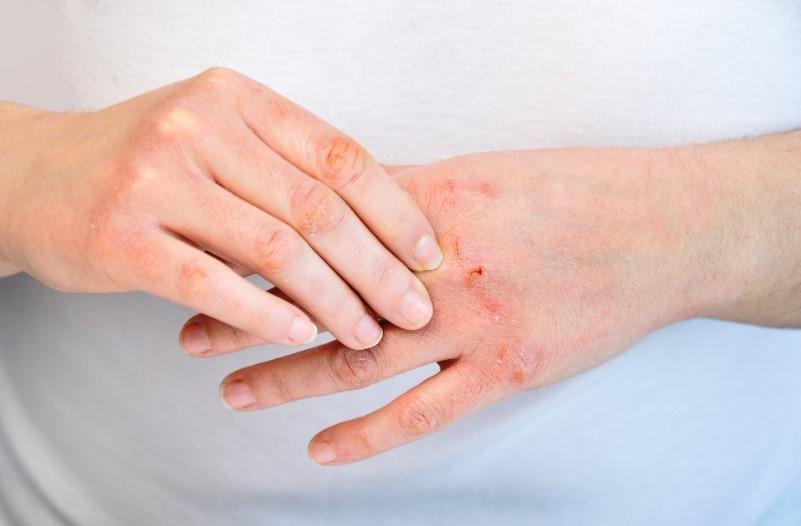 Dermatitis