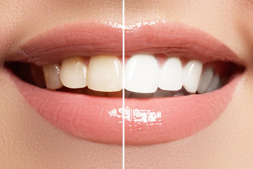 teeth whitening crestview fl