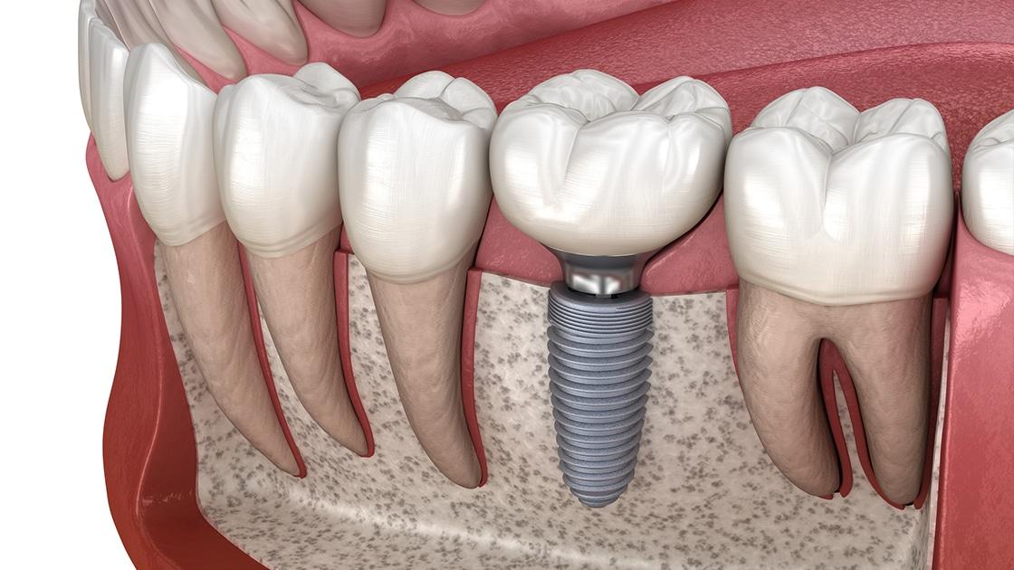 dental implant Manhattan