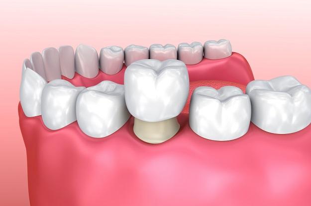 dental crowns houston