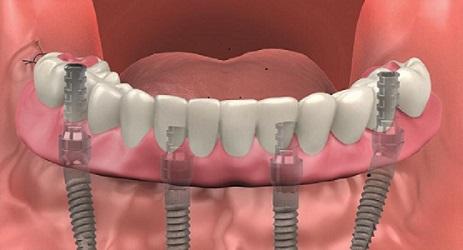 all-on-4 dental implants near me