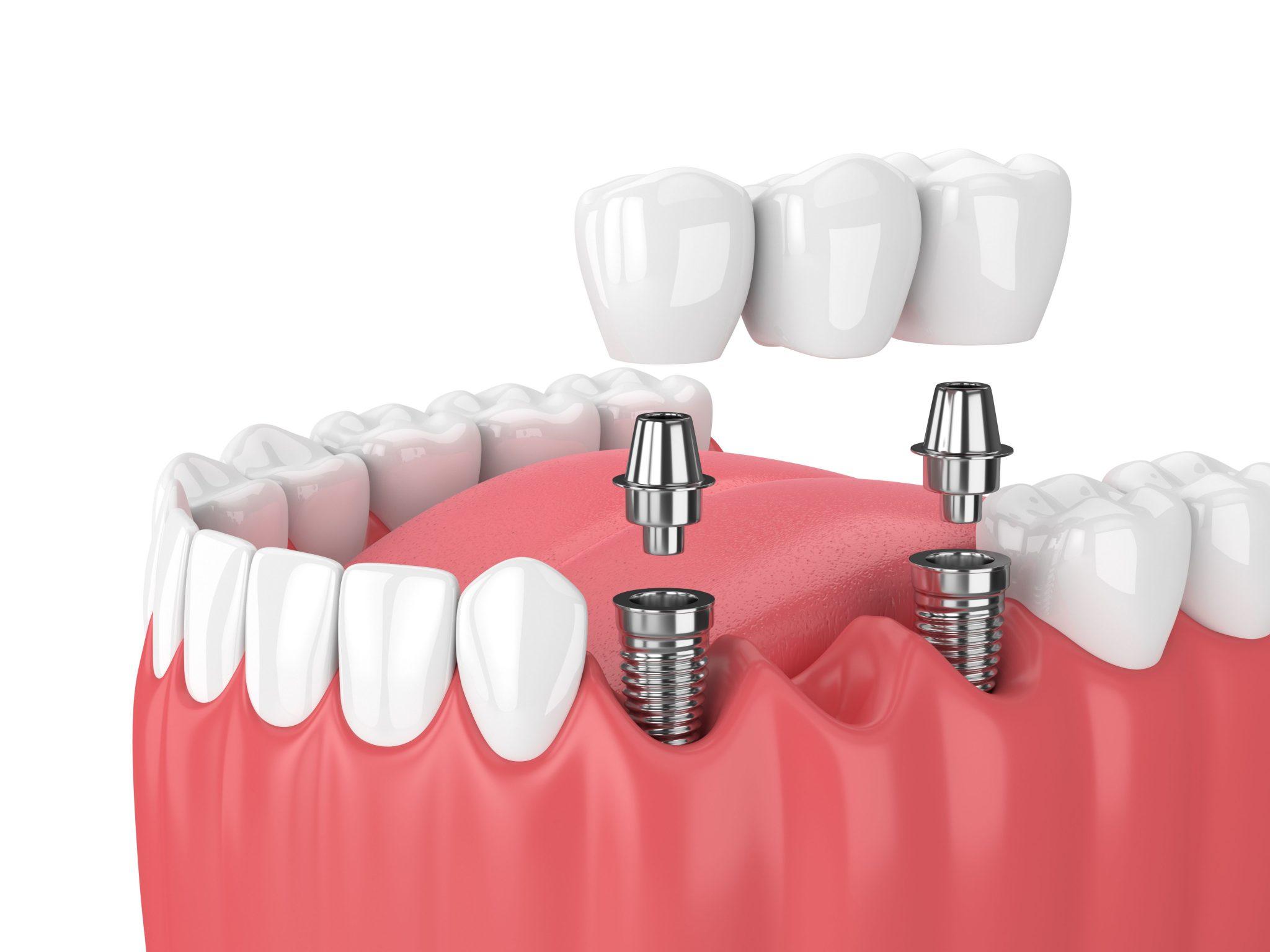 immediate all on 4 dental implants