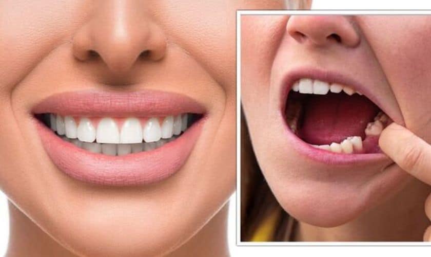 Teeth Replacement in Peoria, AZ