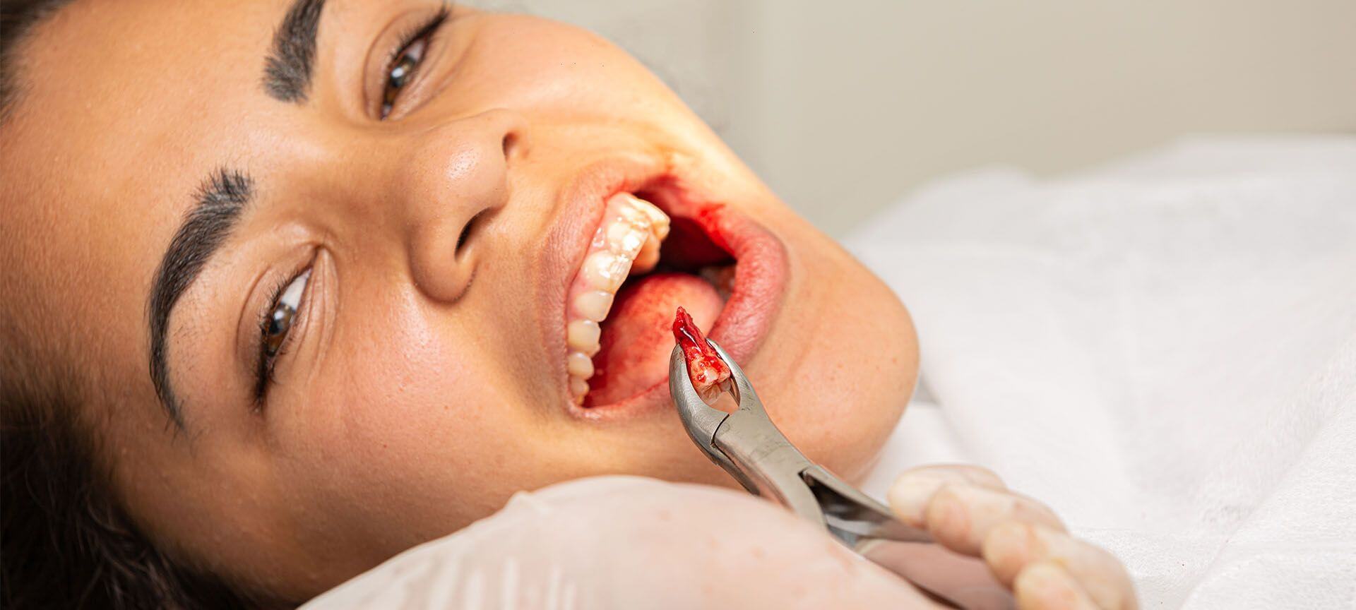 Wisdom Teeth Removal in Peroia