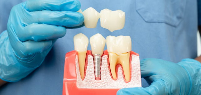 dental implant vs. dental bridge