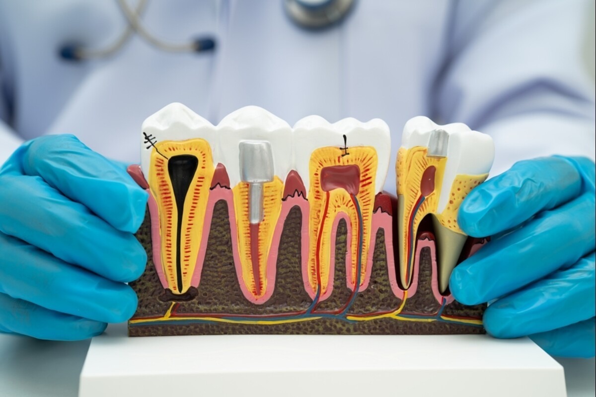 root canal